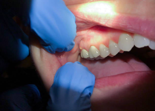 Best Emergency Tooth Extraction  in Oakwood, IL